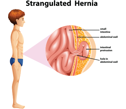 Hernia in Marathi